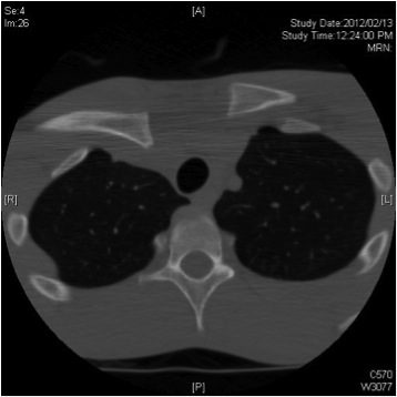 CT Posterior SCJ Dislocation